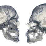 Venas diploicas en individuos con craneosinostosis Eisova et al Diploic veins/Eisova et al