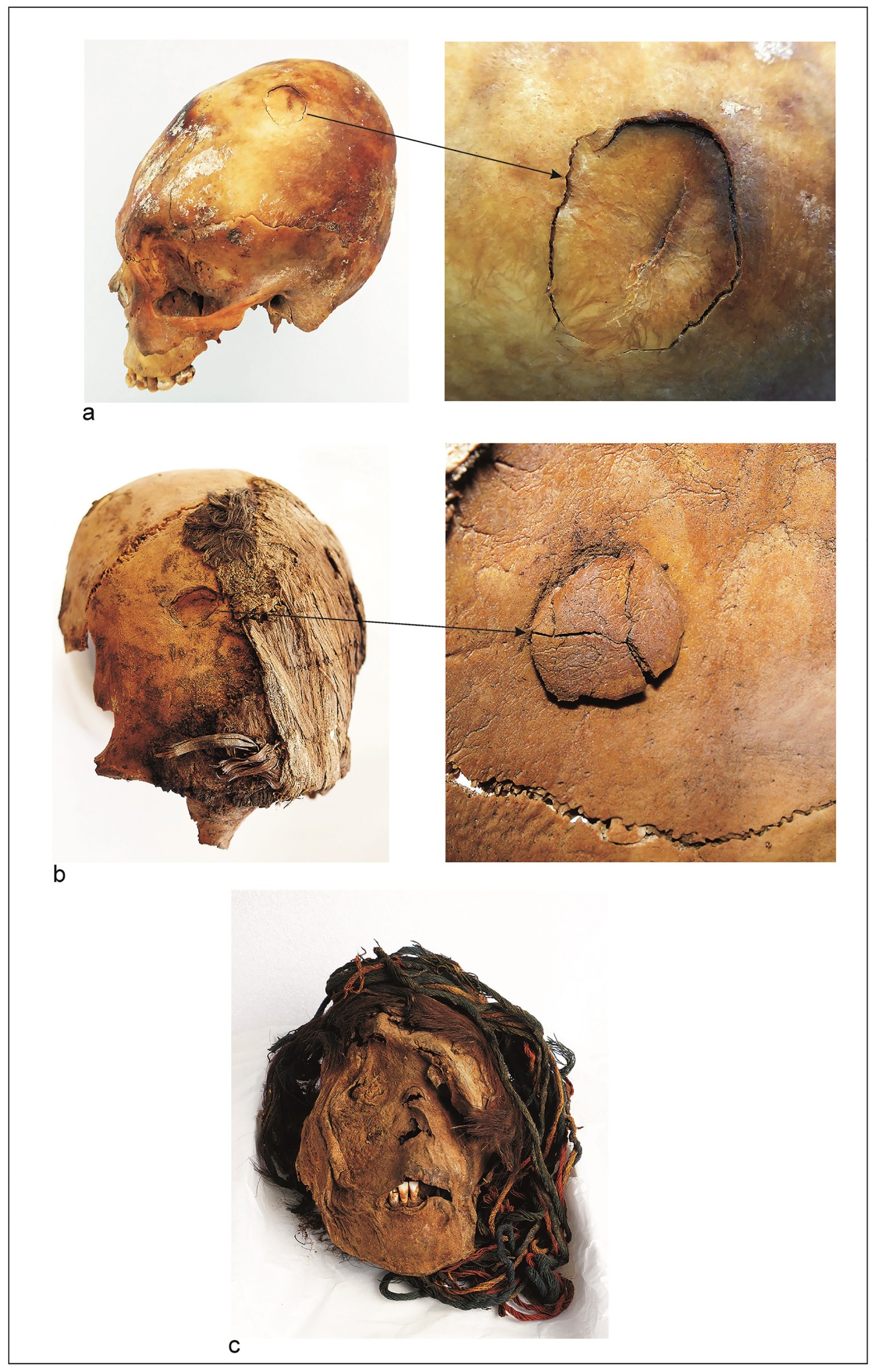 Perimortem cranium fractures, Formative Period.