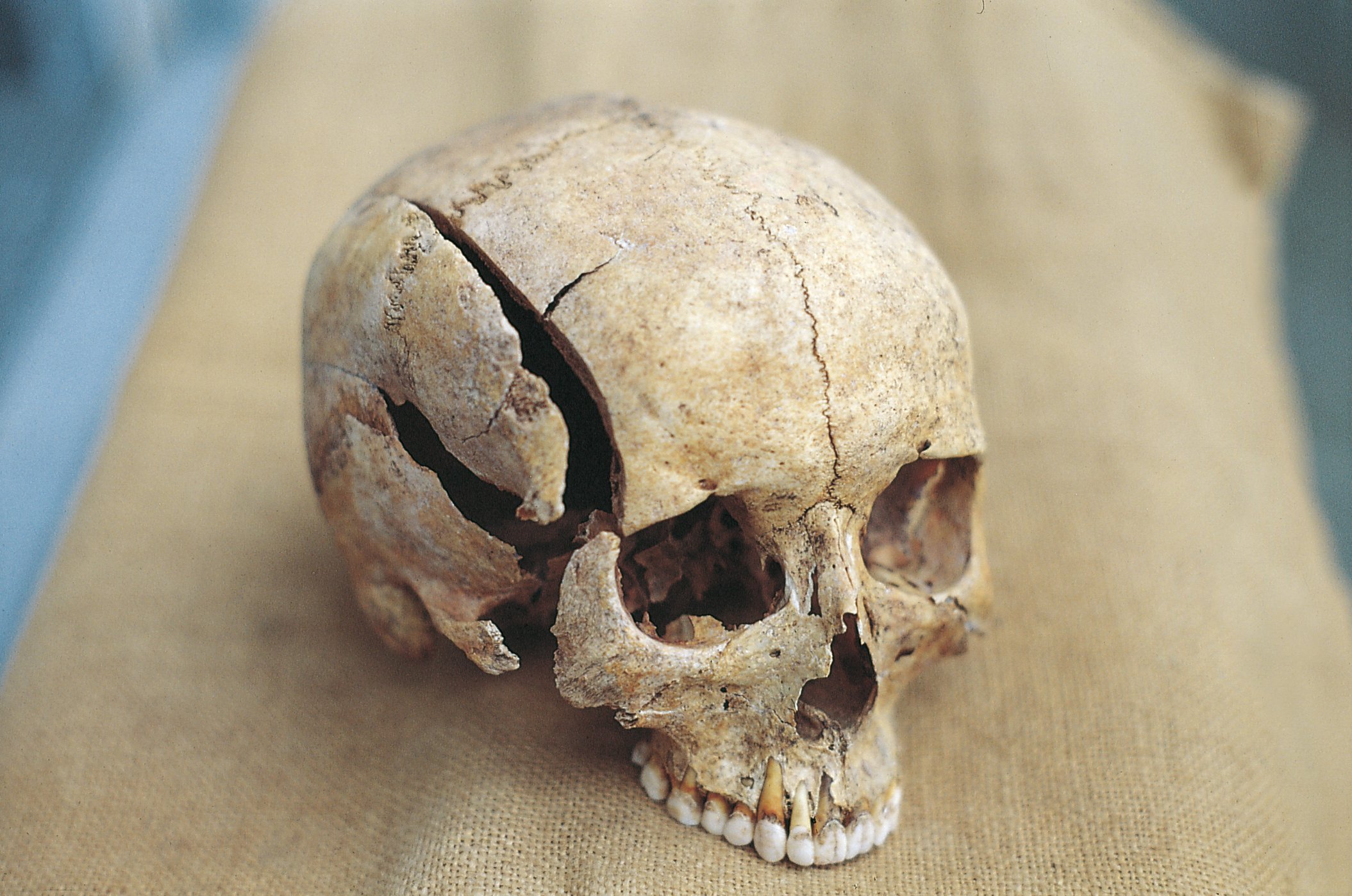 Schädeltraumata Konflikten ersten Städte A cranial trauma bears witness of a violent death. Photo: Joachim Wahl / University of Tübingen