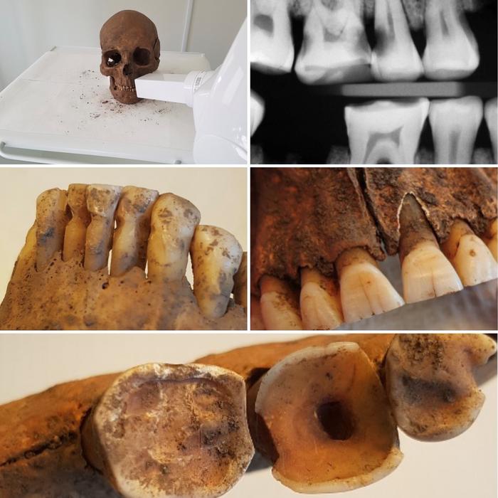 On the bottom a filed hole from the crown of the tooth into the pulp – a procedure that reduces toothache and infection. Credits: Photo by Carolina Bertilsson and Henrik Lund