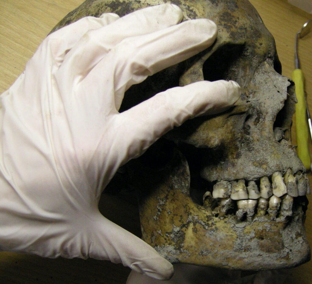 Vikings in Varnhem, Sweden, suffered from tooth decay