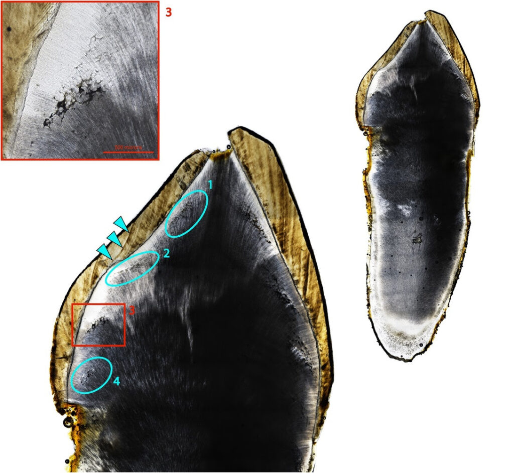 Right permanent maxillary canine of CL 129. Four discrete episodes of IGD (interglobular dentin) in approximately annual increments are apparent. Teal arrows indicate a Wilson band formed concurrently with the 2nd episode of IGD. Image Credits: Snoddy et al., 2024, PLOS ONE, CC-BY 4.0