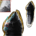 Childhood vitamin D deficiency industrialization England Right permanent maxillary canine of CL 129. Four discrete episodes of IGD (interglobular dentin) in approximately annual increments are apparent. Teal arrows indicate a Wilson band formed concurrently with the 2nd episode of IGD. Image Credits: Snoddy et al., 2024, PLOS ONE, CC-BY 4.0