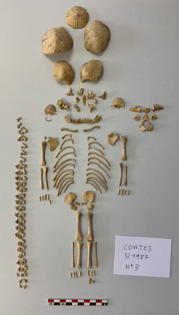 Down Syndrome Iberian Peninsula's Iron Age Skeleton of a baby girl with Down Syndrome who died with a gestational age of around 28 weeks. (© Foto J.L. Larrión, Gobierno de Navarra)