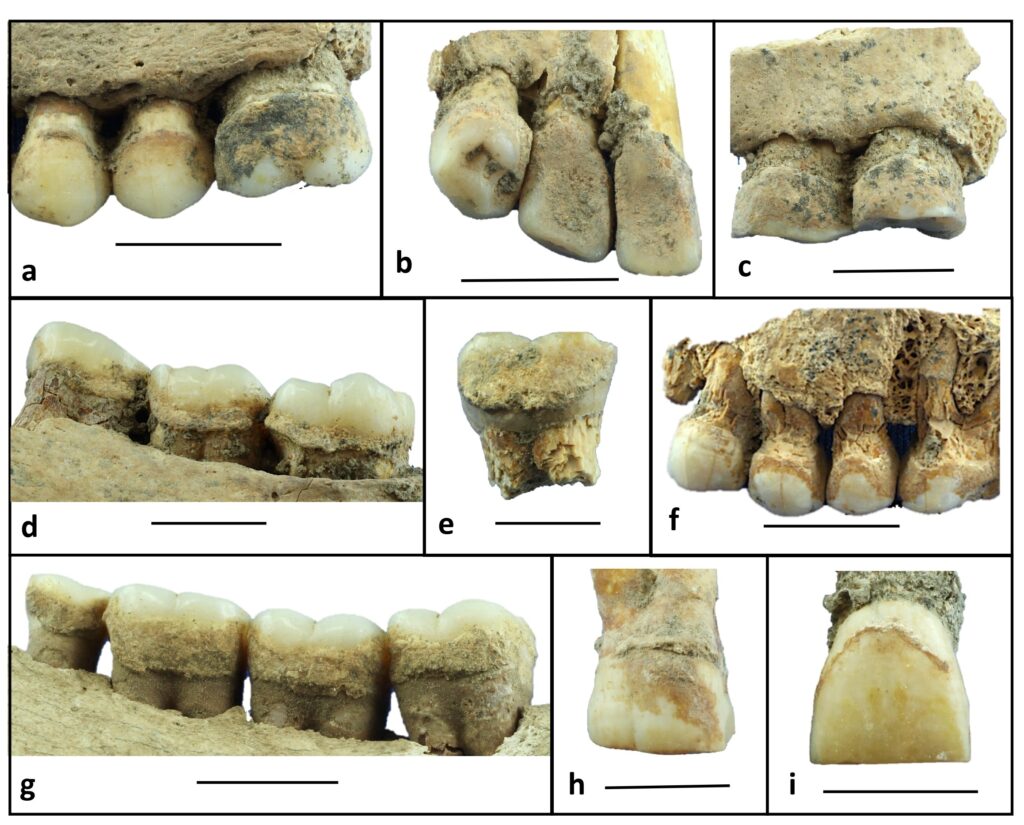 tartaro dentale Sudan Neolitico