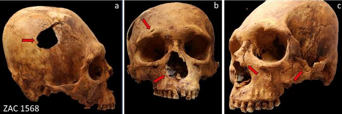 violence after collapse of the Chavín culture Various traumatic injuries in one of the individuals studied: a) perimortem penetrating fracture in right parietal produced by blunt force trauma; b) cut mark in right superciliary arch relating to sharp force trauma, and perimortem injury relating to stone flake, which remains embedded in right wall of nasal pyriform aperture; c) healed linear penetrating fracture and cut marks in left zygomatic bone relating to sharp-blunt force trauma, and healed nasal fracture. Credits: Luis Pezo-Lanfranco