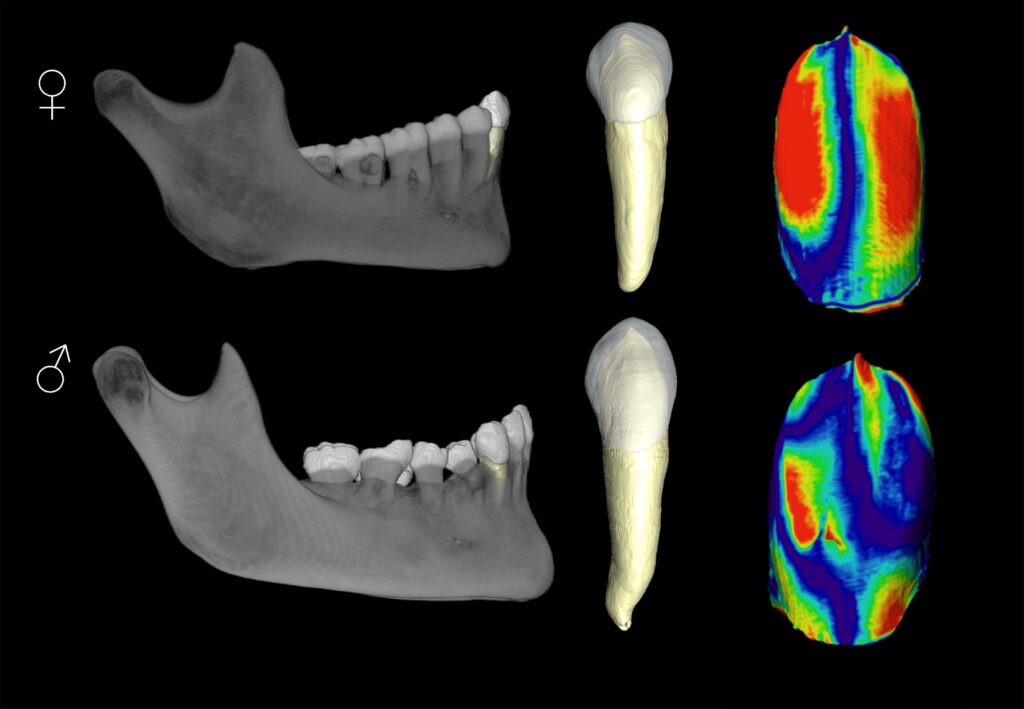 Main differences in dentin morphology of permanent canines of males and females from current populations/C. García Campos