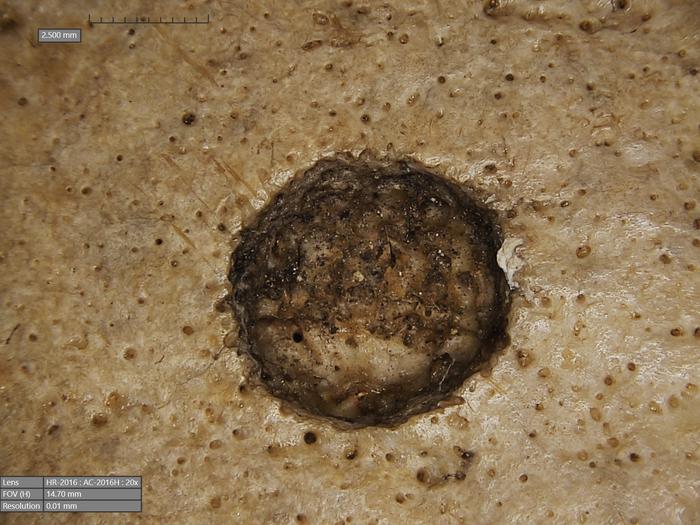 Several of the metastatic lesions on skull236 display cutmarks. Image Credits: Tondini, Isidro, Camarós, 2024