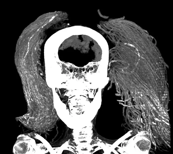 The mummy wearing her two-part wig. Credits: Sahar Saleem, CC BY