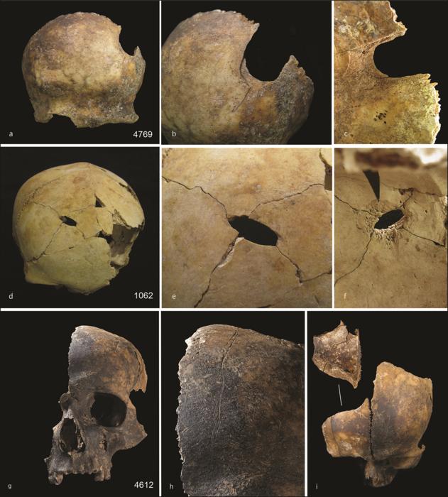 Examples of cranial trauma. Top) perimortem injury to the left posterior of the frontal bone (a), cutmarks can also be seen on the frontal bone (b) and patinated bevel of the internal cranial surface is apparent around the injury (c); middle) cranium with a perforating injury to mid-frontal bone (d), a closer view shows radiating fracture lines (e) and the internal view shows patinated bevel (f ); bottom) adult cranium (g), close inspection shows cutmarks running along the mid-frontal (h) and a perimortem blunt force fracture to the conjoining right frontal bone fragment (i) Images by Schulting et al. Antiquity, December 2024