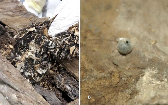 Left: Removal of parts of the foreign material from the dorsal abdominal wall revealed a mixture of fragmented white fabric, small wood chips, and plant material along with some brownish amorphous tissue residues. Right: The round foreign sphere detected in the left pelvis had a small hole with a raised lip. Credit: Andreas Nerlich
