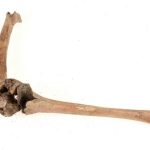Middle Ages disabilities Lund The femoral fracture in grave 2399 with the tibia repositioned to show the 45-degrees angulation. Photo Credits: Nelly Hercberg, Cultural Museum in Lund