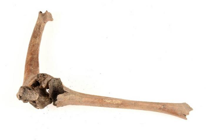Middle Ages disabilities Lund The femoral fracture in grave 2399 with the tibia repositioned to show the 45-degrees angulation. Photo Credits: Nelly Hercberg, Cultural Museum in Lund