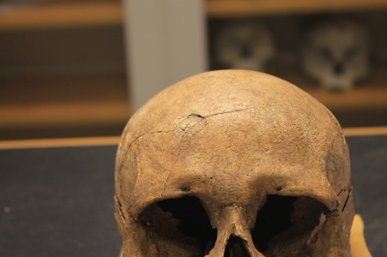 This skull of a female from a burial mound in what is now Ringsaker shows evidence of a blunt force injury that happened just prior to or during the woman's death. The blow caused a semi-circular depression in the skull with radiating lines. Photo: Lisa Mariann Strand