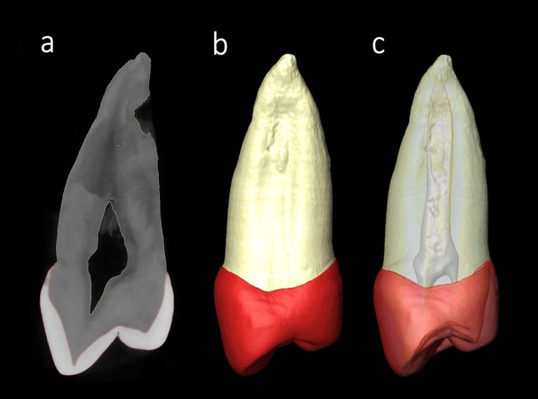 Evidencias dentales en Atapuerca apoyan vínculos evolutivos con neandertales y 'Homo sapiens': un estudio comparativo Premolar de Sima de los Huesos/Martín-Francés et al. Sima de los Huesos premolar/Martín Francés et al.